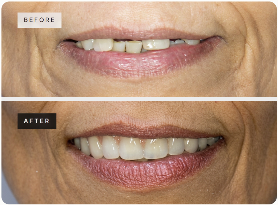 Composite bonding before and after