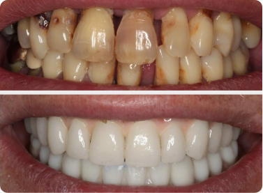 Before and after